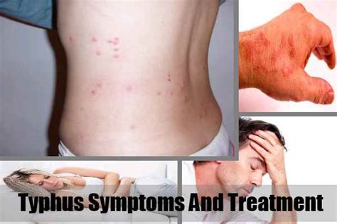 Typhus Symptoms And Treatment – Natural Home Remedies & Supplements