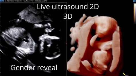 Live ultrasound in 2D/3D at 19 weeks pregnant/Gender reveal - YouTube