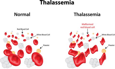 Alpha thalassemia: MedlinePlus Genetics