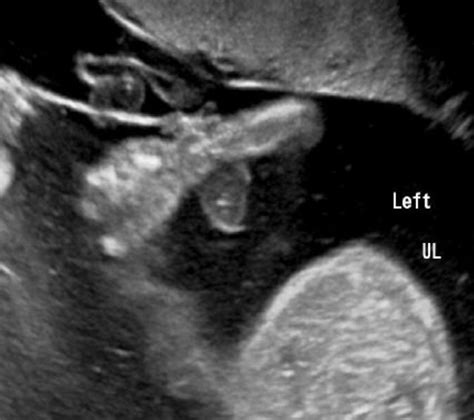 Amniotic Band Sequence - American Journal of Obstetrics & Gynecology