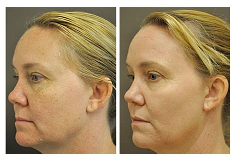 Fractional CO2 Laser Skin Resurfacing - Wrinkles, Sun Damage - San Diego