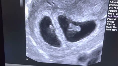 7 Week Ultrasound Identical Twins