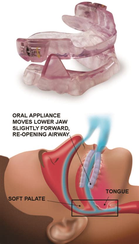 Oral-Appliance-for-Sleep-Apnea - Advanced Dental Concepts Blog