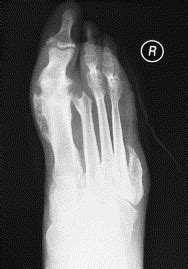 Transmetatarsal Amputations - Clinics in Podiatric Medicine and Surgery