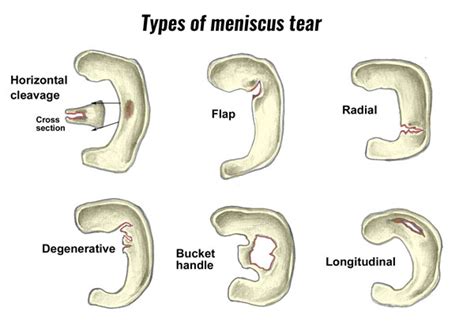 Lateral Meniscus Tear | Symptoms, Causes & Treatment