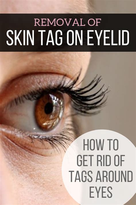 Skin tag on eyelid and eyelash line can lower self esteem, because when ...