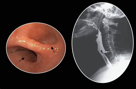 Zenker's diverticulum - MEDizzy