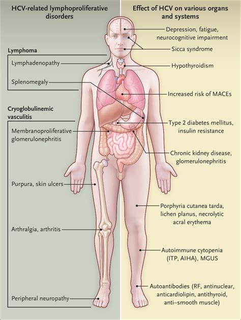 Extrahepatic Manifestations of Chronic HCV Infection | NEJM