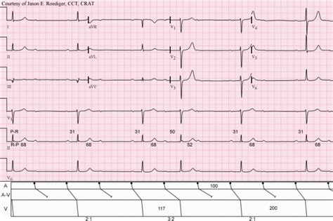 Wenckebach periodicity | ECG Guru - Instructor Resources