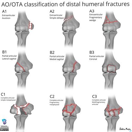 Mechanisms Of Humeral Head Fracture