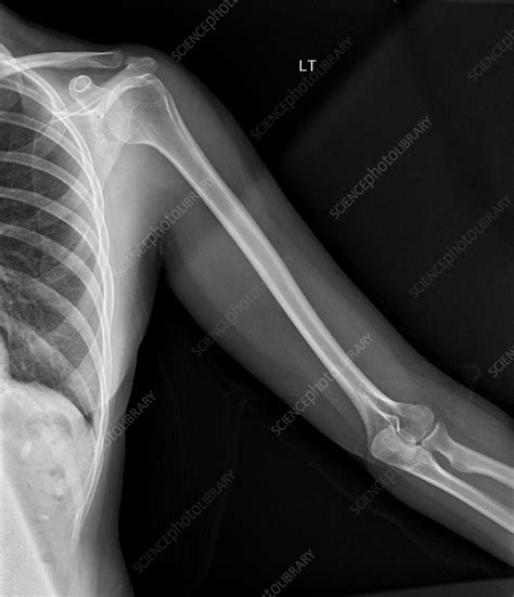 Normal humerus, X-ray - Stock Image - C039/3303 - Science Photo Library