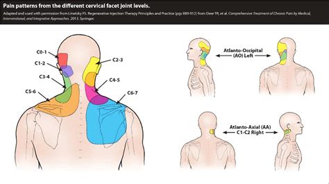 Figure 4 from The Biology of Prolotherapy and Its Application in Clinical Cervical Spine ...