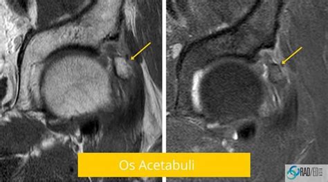 Hip MRI ? Show me the Xray: Acetabular Rim Ossifications. How to make ...