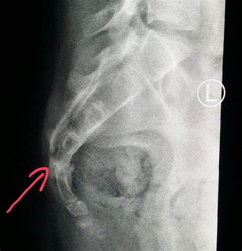 Pin on X-rays