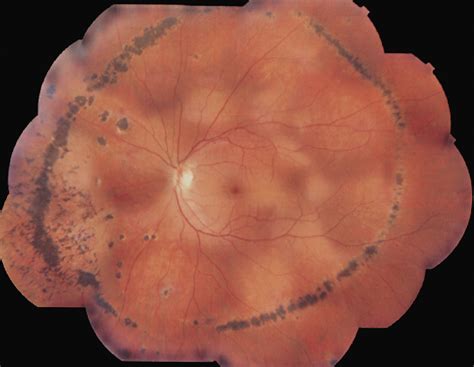 Peripheral Curvilinear Pigmentary Streak in Multifocal Choroiditis | Ophthalmology | JAMA ...