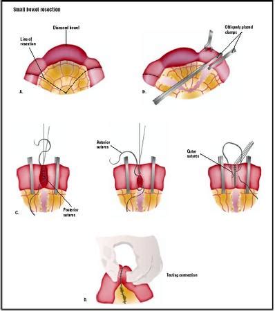 Small Bowel Resection - procedure, recovery, blood, tube, removal, pain, complications, time