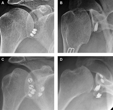 Arthroscopic coracoid transfer. (A, B) Preoperative AP and axial plain... | Download Scientific ...