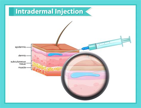 Intradermal Injection Technique