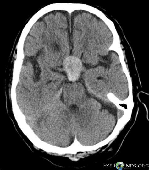 Pituitary Tumor Optic Chiasm