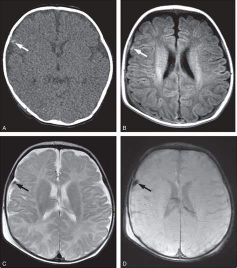 Abusive head trauma: extra-axial hemorrhage and nonhemic collections ...