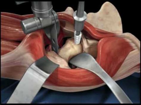 Direct Anterior Approach Hip Replacement | Total hip replacement, Hip ...