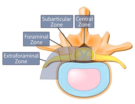 The Difference Between Bulging Disc and Herniated Disc