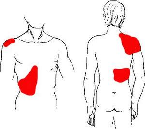 gallbladder pain location diagram