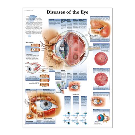 Diseases And Disorders Of The Eye Chartposter Laminat - vrogue.co