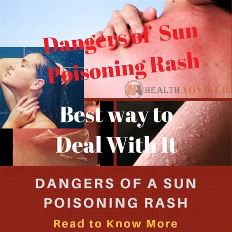 Sun Poisoning: Symptoms, Pictures, Causes and Treatments