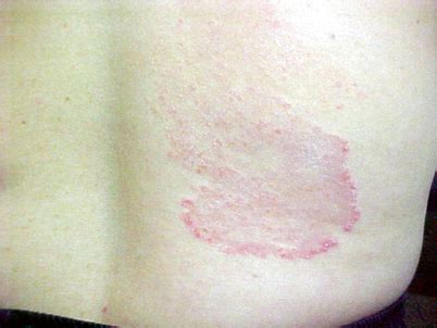 Dermatophytosis (Tinea) and Other Superficial Fungal Infections | Oncohema Key