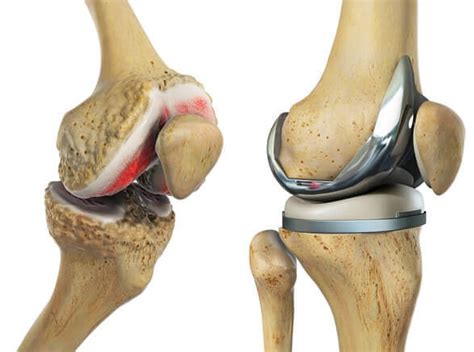 Total Knee Replacement Recovery: What To Expect - Knee Pain Explained