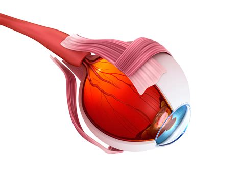 Sickle Cell Retinopathy Focus of Expert Analysis Updating Advice on Managing Disease