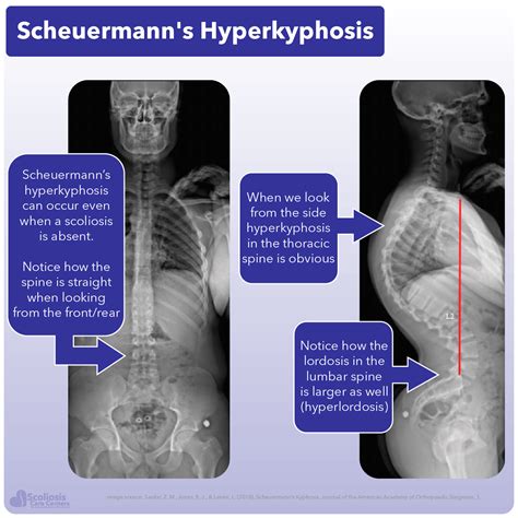 Scheuermann’s Kyphosis Treatments By Our Expert Physicians