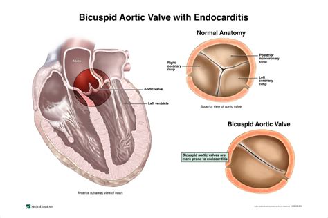 Heart Valve Diseases - Types | NHLBI, NIH