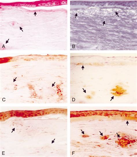 Hereditary corneal dystrophy | Semantic Scholar