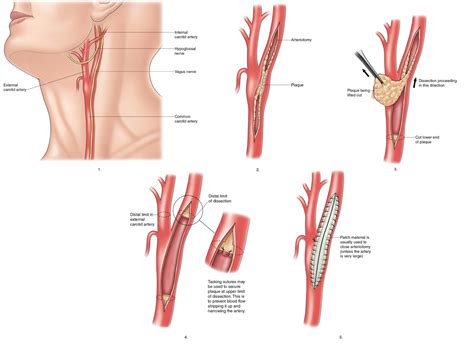 carotid endarterectomy surgery | Cardiovascular, Pensamentos