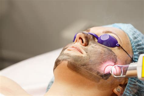 Carbon Laser Facial Treatment – Advanced Medical Aesthetics