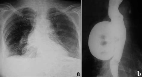 Video Assisted Thoracoscopic Surgery (VATS) Excision of Midthoracic Esophageal Diverticula | CTSNet