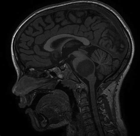 Diffuse Intrinsic Pontine Glioma: A Therapeutic Challenge | IntechOpen