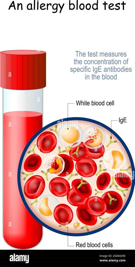 allergy blood test. The test measures the concentration of specific IgE antibodies in the blood ...