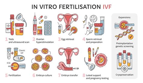 In Vitro fertilization IVF vector infographic and infertility treatment ...