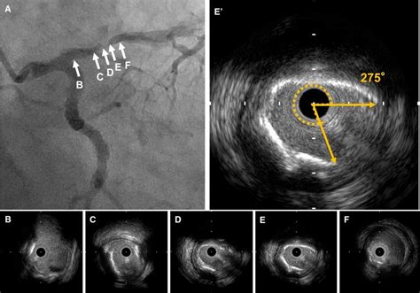 Representative case of intravascular ultrasound-detected attenuated... | Download Scientific Diagram