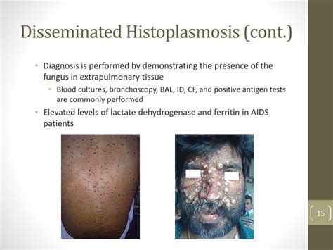 Histoplasmosis Symptoms