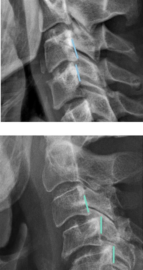 Painful and Degenerative Cervical Spine | Radiology | U of U School of ...