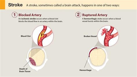 Stroke Also called: CVA, cerebrovascular accident - Medix Urgent Care ...