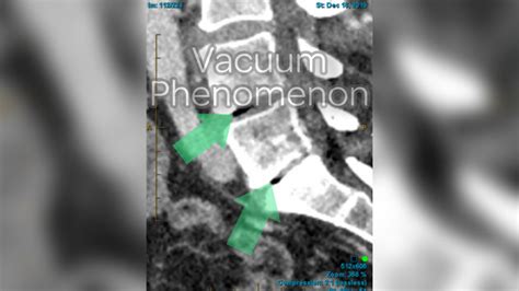 Vacuum Phenomenon - What is it and can it tell us anything?