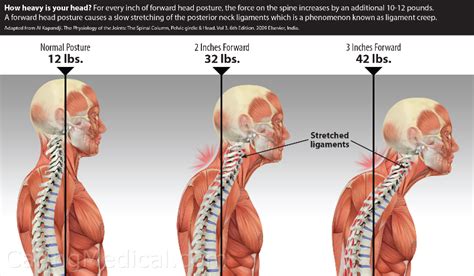 How to Correct Your Posture to Release Upper Back And Neck Pain