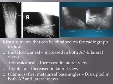 Congenital vertical talus