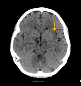 Middle Cerebral Artery Stroke - Radiology For Beginners by Dr. Samuel Kobba