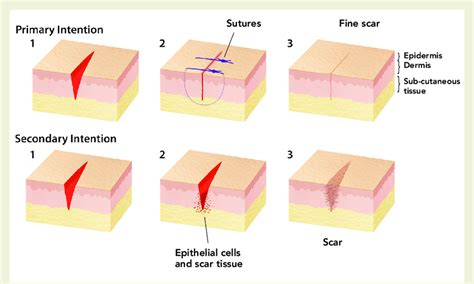 Difference in wound healing between primary and secondary intention ...